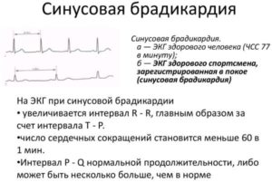Боль в сердце при синусной брахикардии