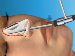 Как легче для пациента удалить шип в носу