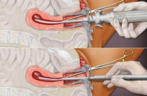 Лечение после замершей беременности