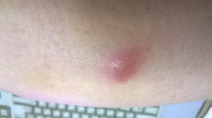 Красные пятна с уплотнением чешутся (шишки)