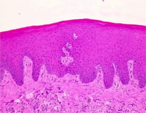 Лейкоплакия вульвы