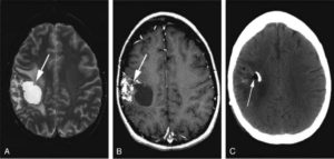 Киста головного мозга