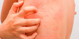 Пищевая и лекарственная аллергия у пожилого человека. Sos!