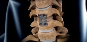 Боли после операции по удалению грыжи шейного отдела