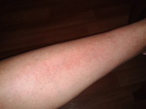 Красная сыпь на ноге