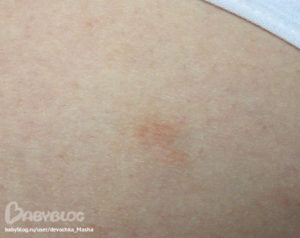 Красные пятна на коже с корочкой