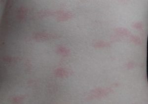 Красные пятна и боль