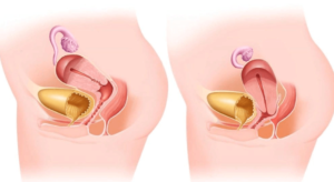 Матка низко