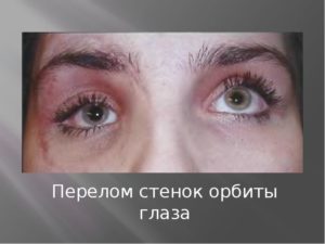 Перелом орбиты глаза