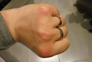 Красные пятна на коже (внешняя сторона ладони)