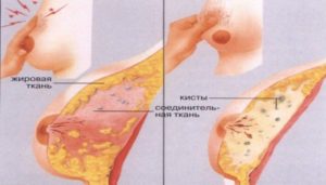 Болит грудь перед месячными