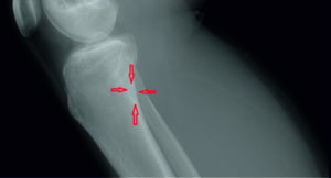 Киста большеберцовой кости у девочки 13 лет
