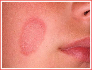 Красные пятна на коже с корочкой