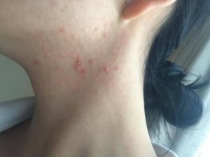 Красные высыпания прыщей, на шее сзади