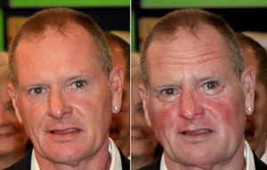 Краснеет лицо и тело после употребления алкоголя