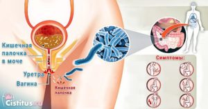 Кишечная палочка во влагалище