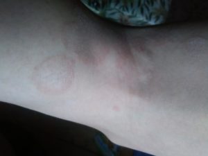 Красные, круглые пятна на нонах и руках, не чешутся