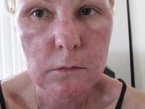 Корочки после лазерной шлифовки