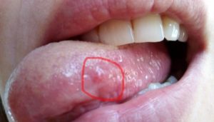 Болит горло и бугорки на языке