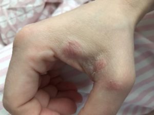 Болячка чешется