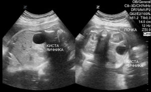 Киста яичника плода