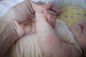 Красное пятно у мальчика 6 мес