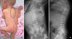 Хруст позвоночника у трехмесячного ребенка