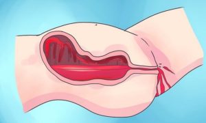 Кровь во влагалище