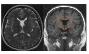 Кистозно расширенная полость Верге