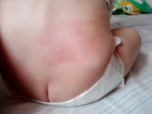 Красное пятно у мальчика 6 мес
