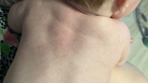 Мелкая сыпь на спине у двух детей и матери