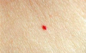 Красная точка на родинке