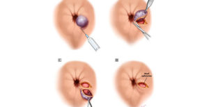 Кровь из анального отверстия после тренировок по бодибилдингу