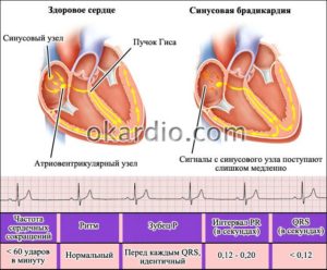 Боль в сердце при синусной брахикардии