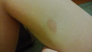 Красное шершавое пятно на бицепсе