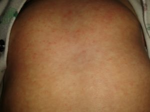 Мелкая сыпь на спине у двух детей и матери