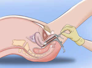 Мазок после секса
