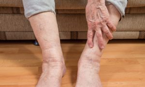 Болит кожа при варикозе