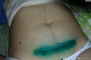 Болит послеоперационный шов