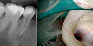 Боль в зубе после пломбирования каналов