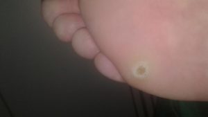 Болячка на ступне