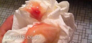 Кровь при беременности после ПА