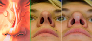 Как легче для пациента удалить шип в носу