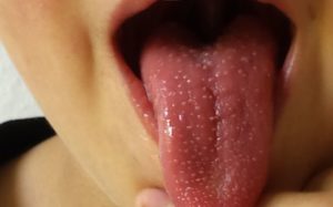 Болит горло и бугорки на языке