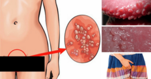 Как предотвратить молочницу после бассейна