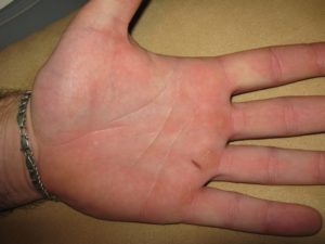 Болит кожа на ладонях рук