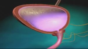 Лечение недержания гиалуроновой кислотой