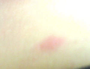 Красные пятна похожие на засовы по всему телу