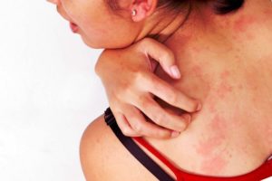 Инфекция или аллергическая реакция на Glo?