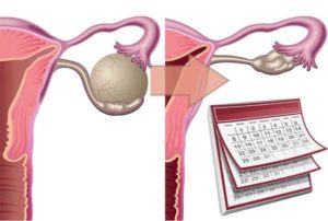 Киста яичника и рост волос на теле